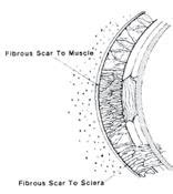 Anatomy of the posterior Tenon's capsule. | Download Scientific Diagram