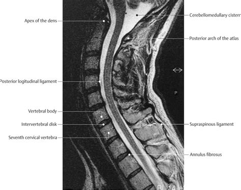 Anterior Longitudinal Ligament Mri