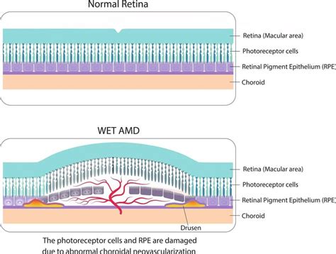 Wet Vs Dry Macular Degeneration Whats The Difference Discover Vision