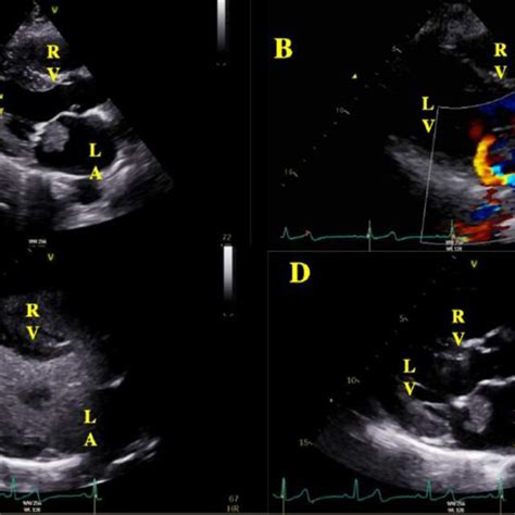 Trans Thoracic Echocardiography A Parasternal Long Axis View Plax