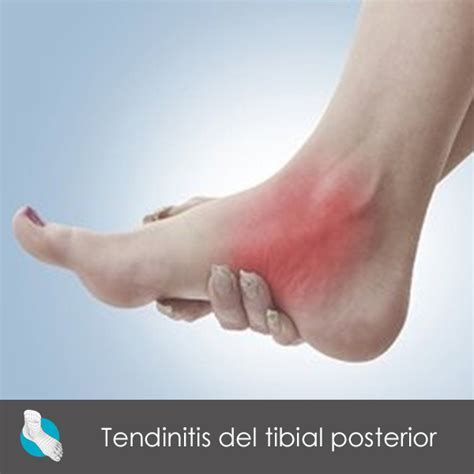 Tendinitis Del Tibial Posterior 9362 The Best Porn Website