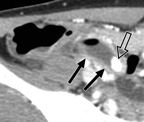 Diagnosis Of Acute Appendicitis With Sliding Slab Ray Sum