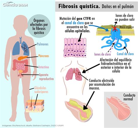 Fibrosis Quística