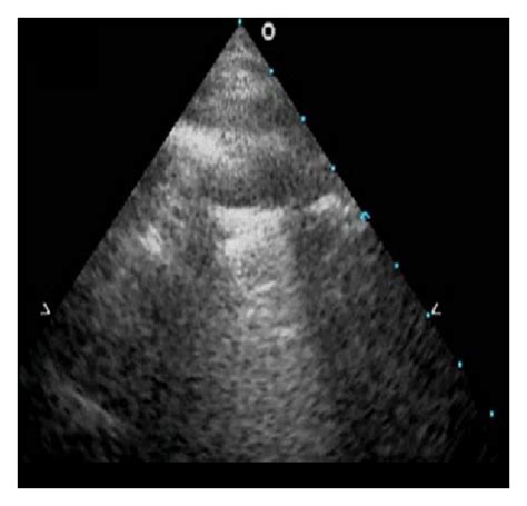 Normal Lung Ultrasound A D Red Arrows Point To The Pleura Where