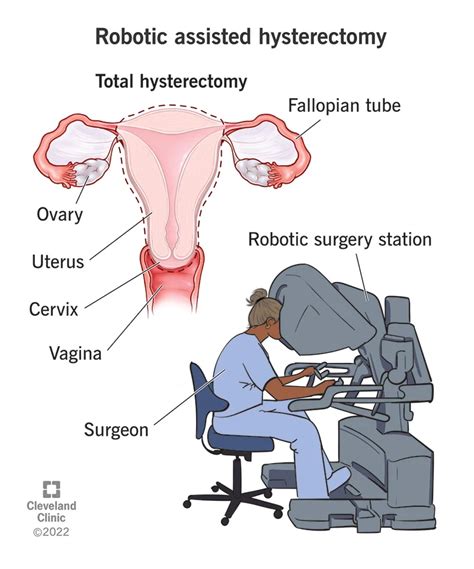 Embracing Robot Assisted Precision Da Vinci Robotic Hysterectomy For A