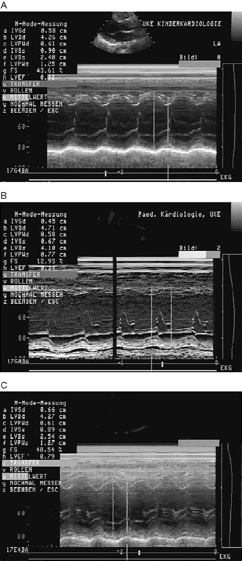 (a) Preoperative echocardiography. Parasternal long‐axis view. M‐mode ...