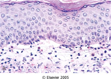 Xeroderma Pigmentosum Histology