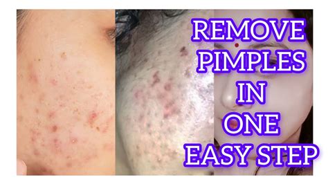 How To Remove Acne Pimple At Home Naturally Youtube