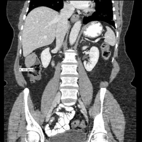 Malt Lymphoma Involving Colon There Is A Diffuse Infiltrate Comprised Download Scientific