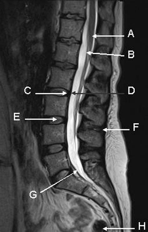 Magnetic Resonance Imaging Of The Lumbar Spine The Bmj