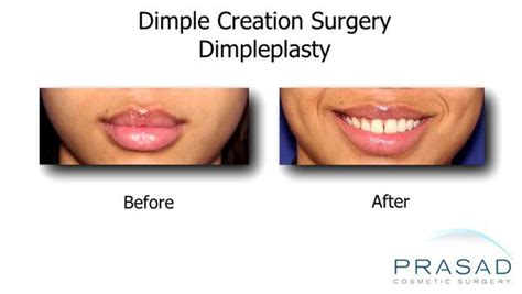 Dimple surgery | Dimple Creation | Learn More - New York