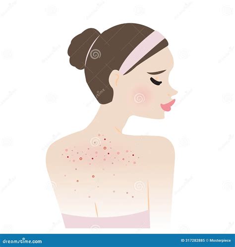 The Woman With Body Acne Vector Illustration Isolated On White