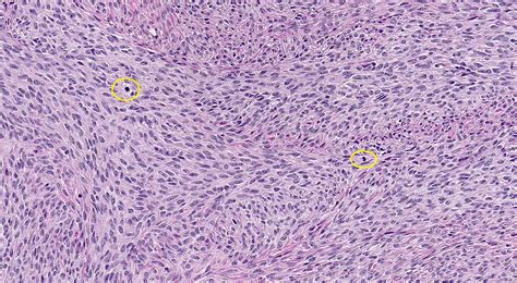 Fibroma Histology