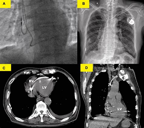 Frontiers Case Report Left Ventricular Perforation Caused By Right