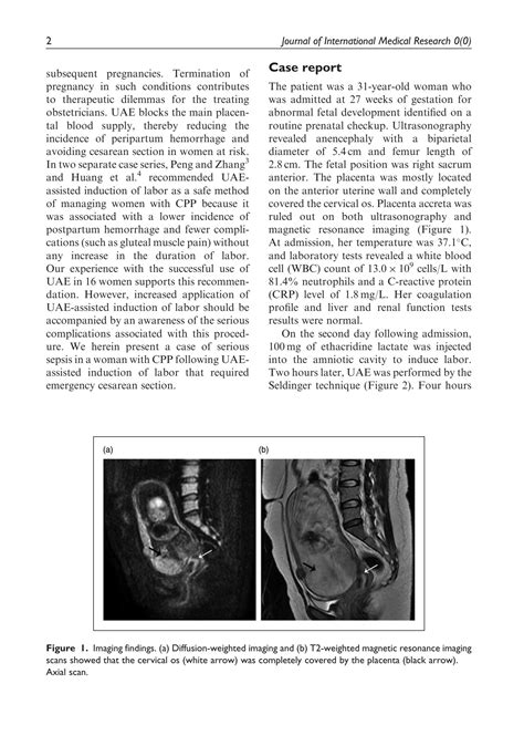 SOLUTION: Sepsis after uterine artery embolization assisted termination