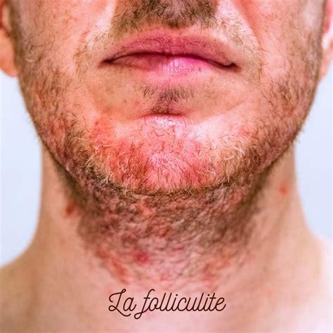 Epilation laser définitive chez lhomme CLEM