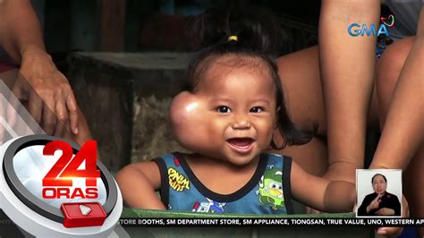 Kondisyon Ng Batang May Malaking Bukol Sa Pisngi Idinulog Sa GMA