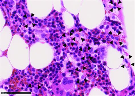 Bone Marrow Biopsy Hematoxylin And Eosin Stained 400× Showing