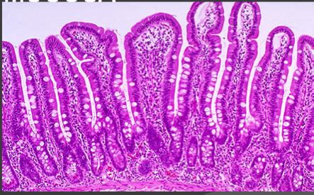 Lower Gi Pathology Flashcards Quizlet