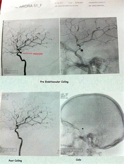 Embracing Change: A Brain Aneurysm – as I understand it.