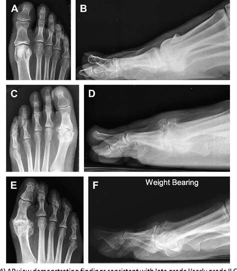 Figure 3 From End Stage Osteoarthritis Of The Great Toe Hallux Rigidus A Review Of The