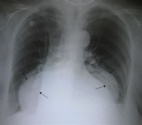 Hiatal Hernia Wikipedia