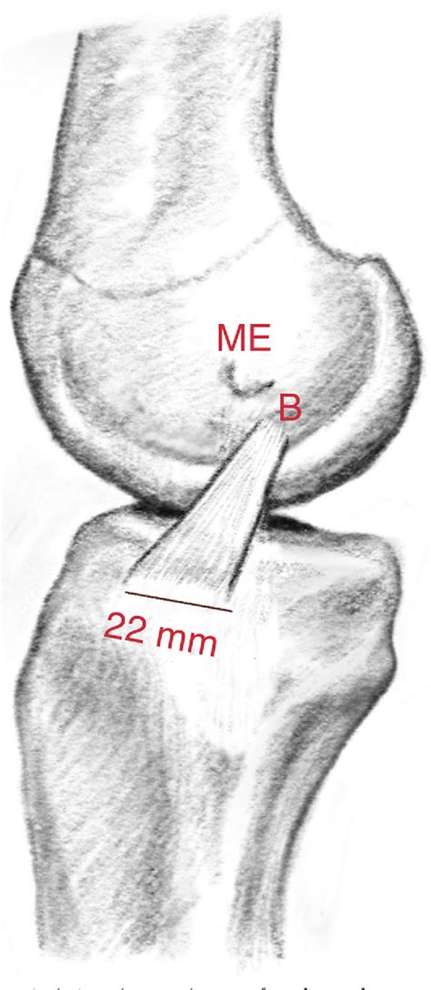 The “figure Of Four” Reconstruction Of The Medial Collateral Ligaments In The Setting Of