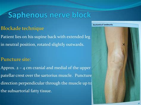 Saphenous Nerve Block