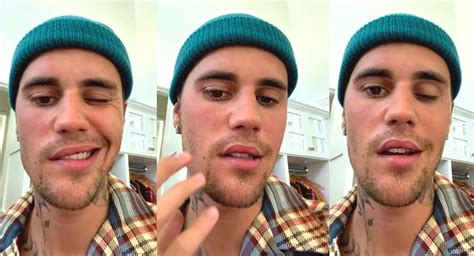 Justin Bieber Reveals Rare Disorder Behind Facial Paralysis Telangana Today