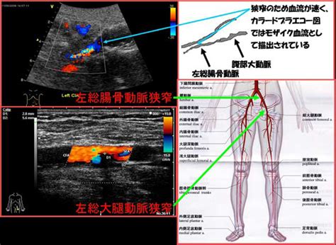 下肢動静脈超音波検査