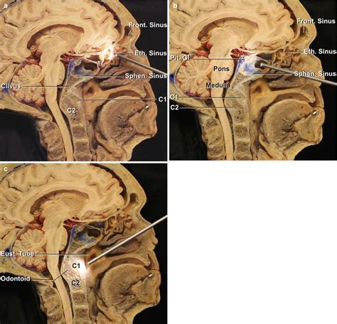 Image Result For Skull Base Clivus Pons Brain Tumor Base Sinusitis