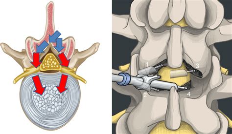 Illustration Of The Route Of Endoscopic System Insertion For Lumbar