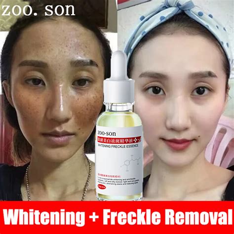 Improve Dull Complexion Niacinamide Anti Melasma Serum Melasma Remover