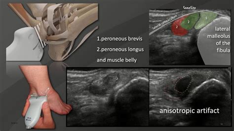 Peroneal Tendonitis Ultrasound