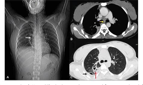 Figure 1 From Imaging Approach To Pulmonary Infections In The Immunocompromised Patient