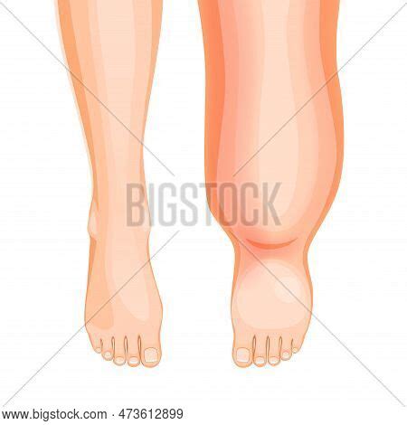 Edema Foot Swollen Vector Photo Free Trial Bigstock