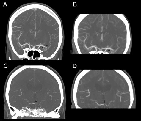 Angiographic Reconstructions From Whole Brain Perfusion CT For The