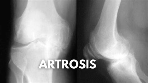 Todo Sobre La Artrosis De Rodilla S Ntomas Y Tratamientos