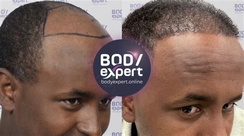 Afro Hair Transplant In Turkey Lower Cost Best Care Body Expert