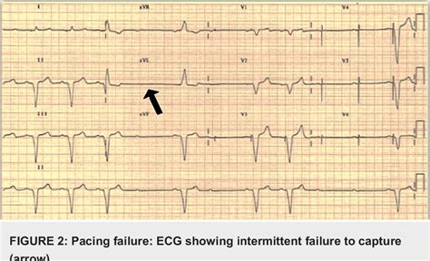 Figure 1 From Pacemaker Malfunction In A Patient With Congestive Heart