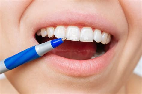 White Spots On Teeth Causes Treatment And Prevention