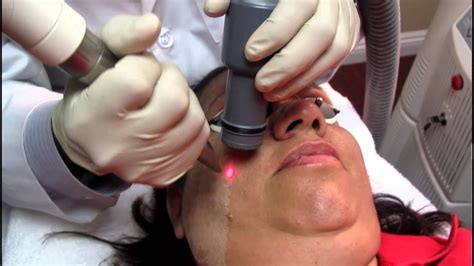 Facial Skin Resurfacing With Fotona Laser In Hacienda Heights YouTube