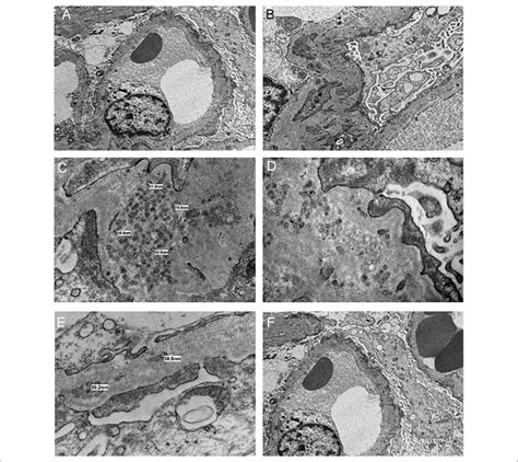 A B Prominent Podocyte Foot Process Effacement C Ultrastructural