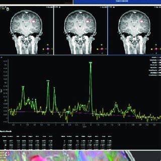 Dynamic Susceptibility Contrast DSC Perfusion Imaging Magnetic