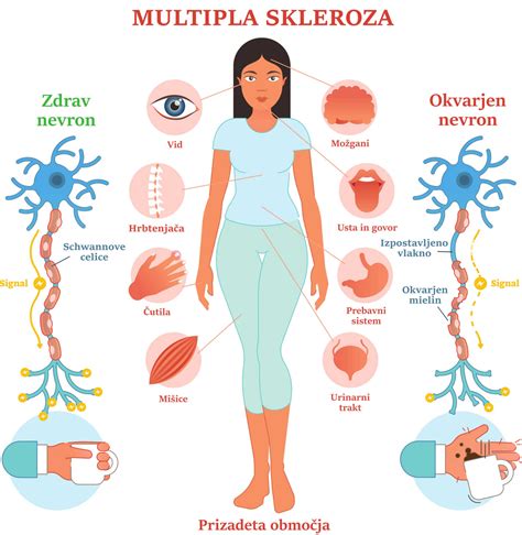 Simptomi multiple skleroze Združenje multiple skleroze Slovenije