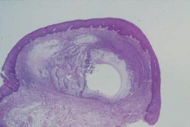 Mucocele Histology