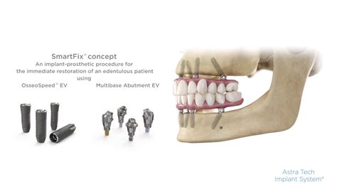 Smartfix® Concept For Astra Tech Implant System® Ev Step By Step