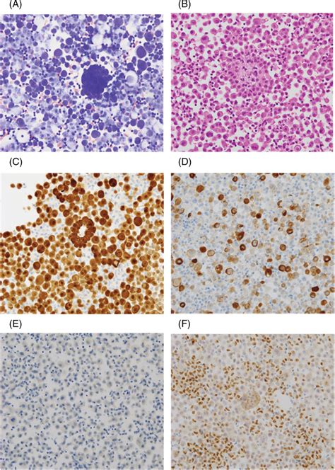 Cytology of the patient's pericardial fluid. Giemsa staining images (A ...