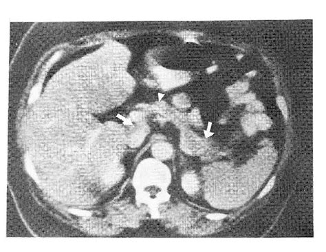 Table 1 From Computer Tomography Ct Finding Of Normal Pancreas Semantic Scholar