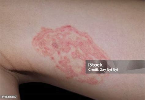 Fungal Infection Called Tinea Corporis In Thigh Of Asian Man Ringworm